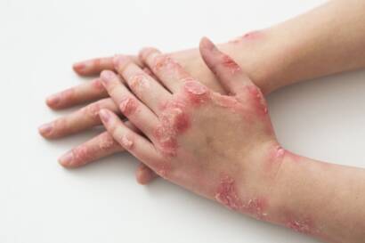 hands-patient-suffering-from-psoriasis-blog