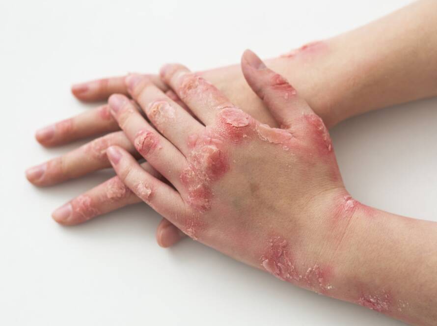 hands-patient-suffering-from-psoriasis-blog