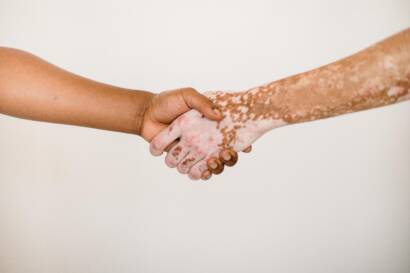 vitiligo-banner