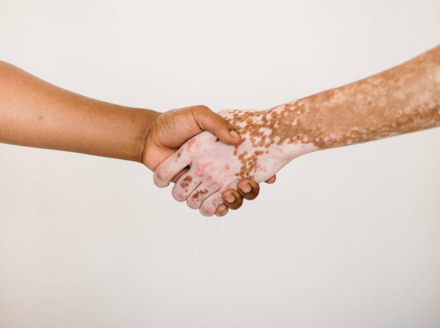 vitiligo-banner